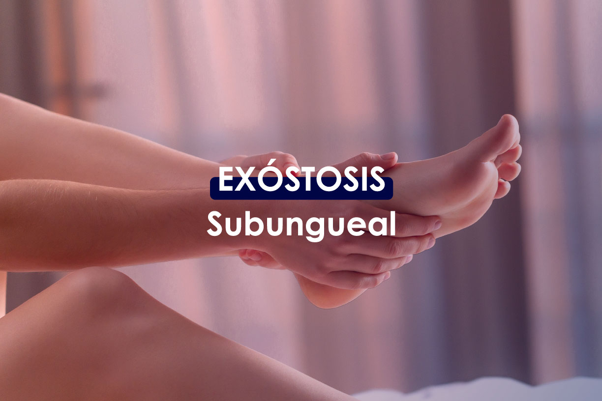 Exóstosis-Subungueal