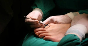 Todo sobre la operación de juanetes: abierta o cirugía percutánea7