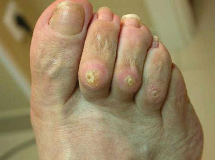 Callos en los pies. ¿Cómo identificarlos y por qué se producen?